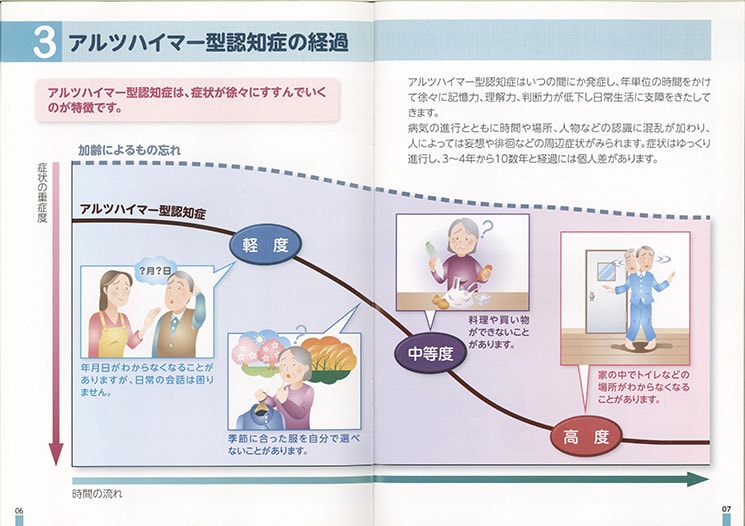 アルツハイマー型認知症